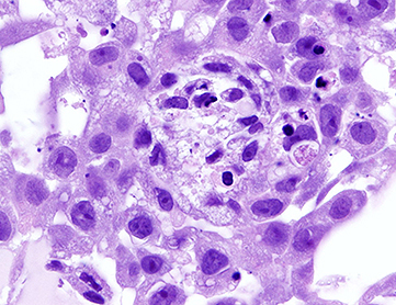 Micro_24_human_lung_bronchioalveolar_carcinoma_cell