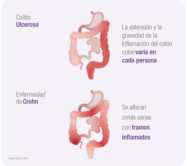 Colitis Ulcerosa Enfermedad de Crohn