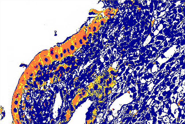 Detalhe microscópico de colite ulcerosa.