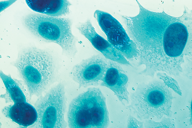 Detalhe microscópico de células humanas na doença de cancro da próstata.