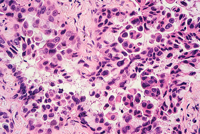 Detalhe microscópico de adenocarcinoma - cancro do pulmão.