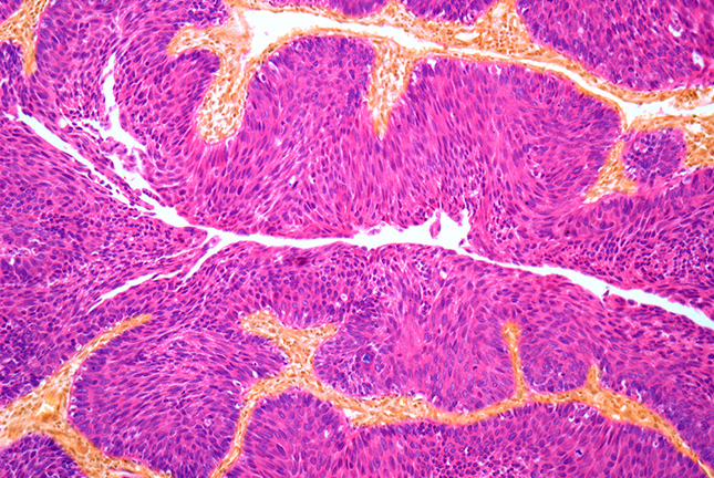 Detalhe microscópico de cancro na bexiga.