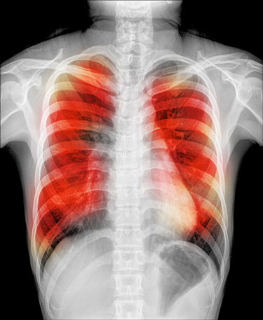 Aktuálna situácia v tuberkulóze na Slovensku 